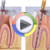 Endodonti Video 1